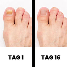 Lade das Bild in den Galerie-Viewer, PureNail - patentierte Nagelpilz-Therapie - für gesunde Nägel innerhalb von 4 Wochen