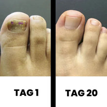 Lade das Bild in den Galerie-Viewer, PureNail - patentierte Nagelpilz-Therapie - für gesunde Nägel innerhalb von 4 Wochen